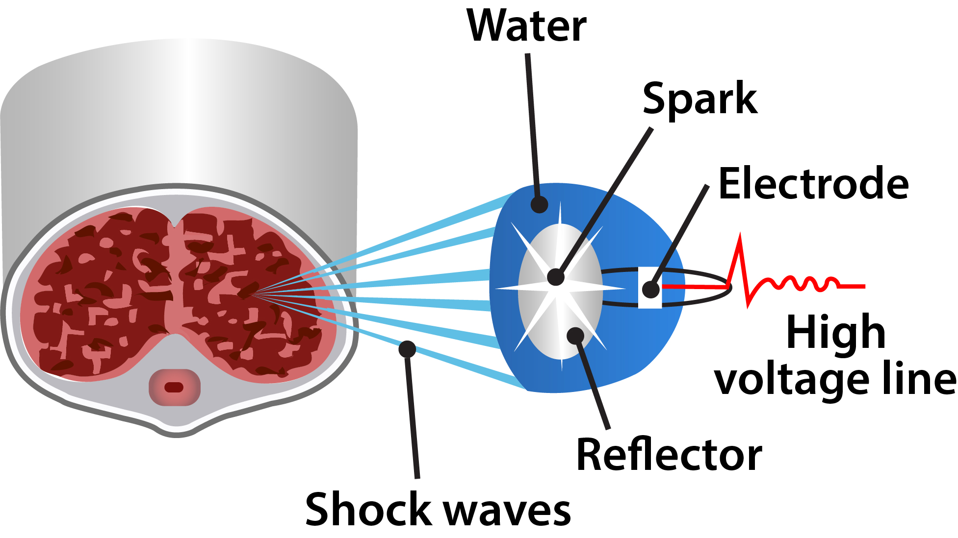 Therapeutic Treatments Using Shockwave Therapy