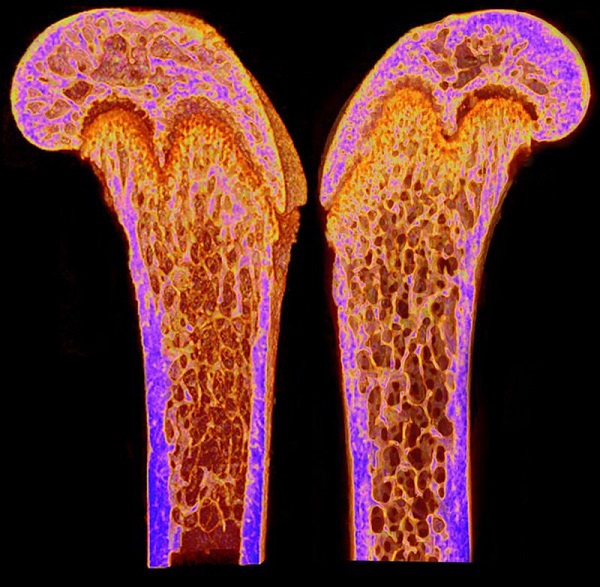 Osteoporosis | Image Credit: "Dlx3 deletion in osteoblast progenitors induce increased trabecular bone formation " by National Institutes of Health (NIH) is licensed under CC BY-NC 2.0